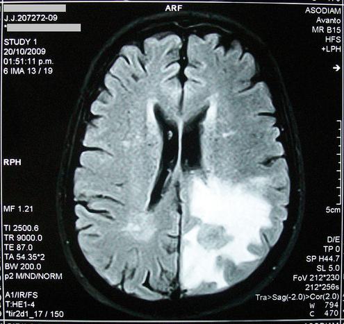 Spezielle Implantate sollen in Zukunft vergessene Erinnerungen wieder hervorholen (Bild: Bobjgalindo CC-BY-SA)
