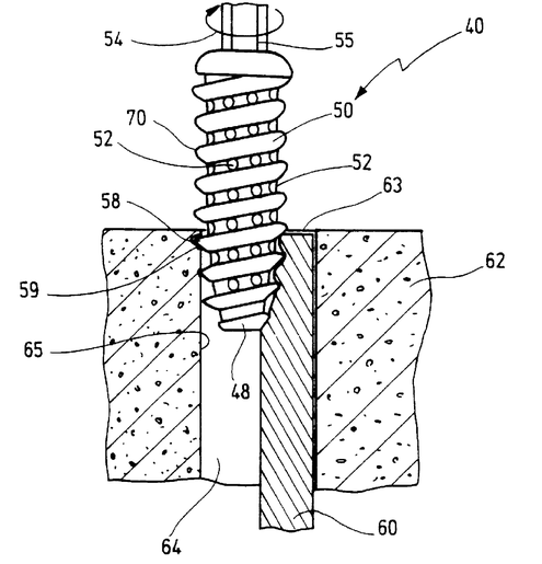 Was die Interferenzschraube in der Chirurgie sind die Suchbegriffe im Onlineshop: Wichtige Stellschrauben für den Erfolg (Bild: US Patent 6,589,245 A. Weiler, M. Strobel, A. Timmermans [1])