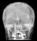 Hirnstimulation mittels Elektroden Hirnstimulation mittels Elektroden